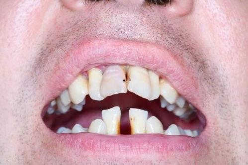 吃石头瓜牙齿酸软,酸软体验背后的科学解析